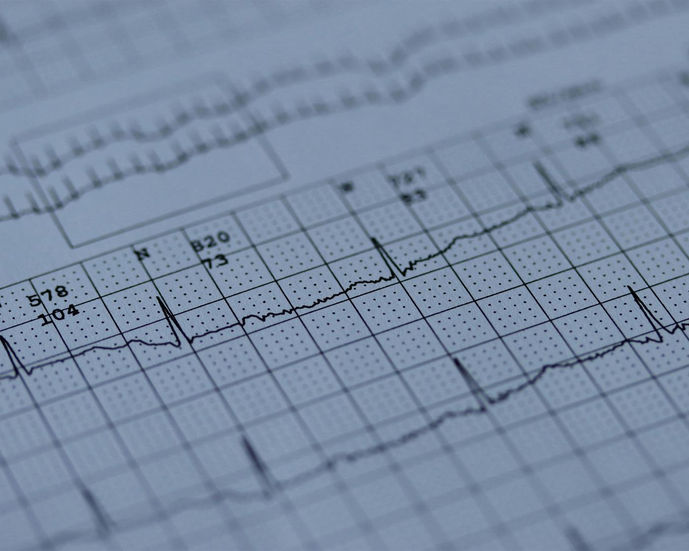 EKG auf einem Blatt Papier